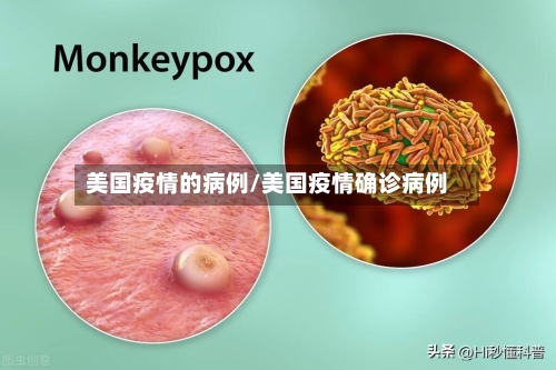 美国疫情的病例/美国疫情确诊病例