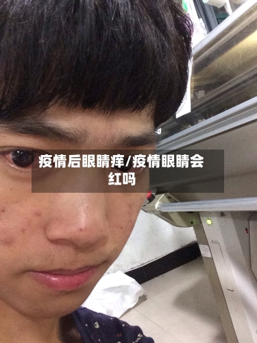 疫情后眼睛痒/疫情眼睛会红吗